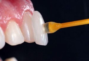 carillas dentales